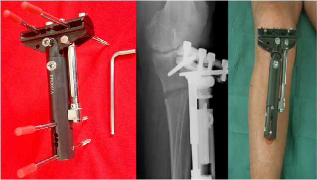 trauma FIJADOR EXTERNO DE OSTEOTOMÍA DE TIBIA PROXIMAL 