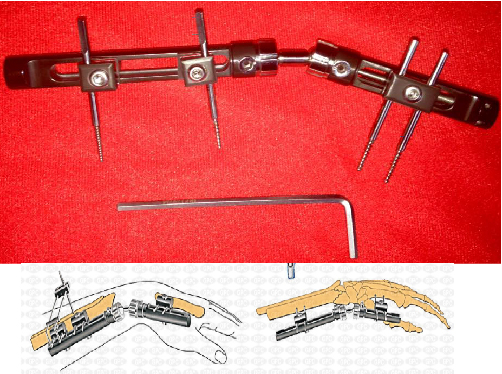 trauma FIJADOR EXTERNO DINÁMICO DE MUÑECA PENNING 